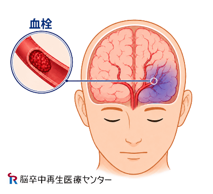 脳梗塞の後遺症のイメージ