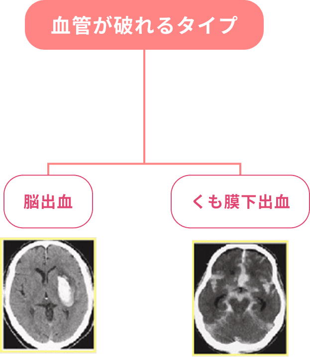 血管が破れるタイプ（脳出血・くも膜下出血）の分類図